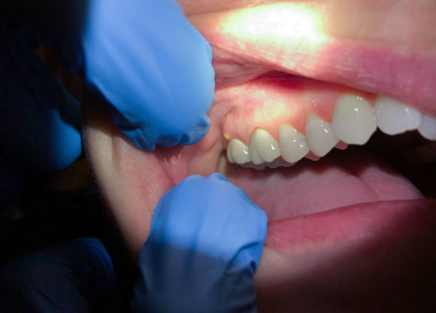 Best Emergency Root Canal Treatment in Cottonwood, CA